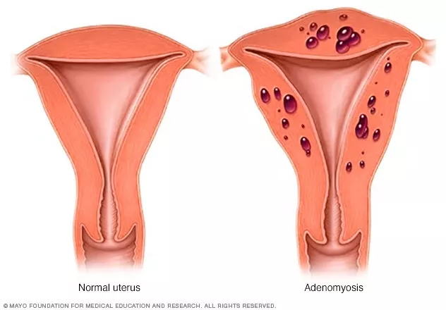 difference between endometriosis and adenomyosis